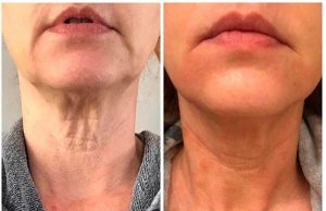 Resultados do endolaser corporal: antes e depois