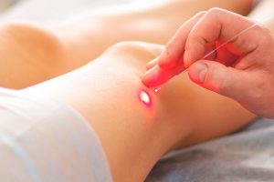 Riscos e cuidados do endolaser corporal